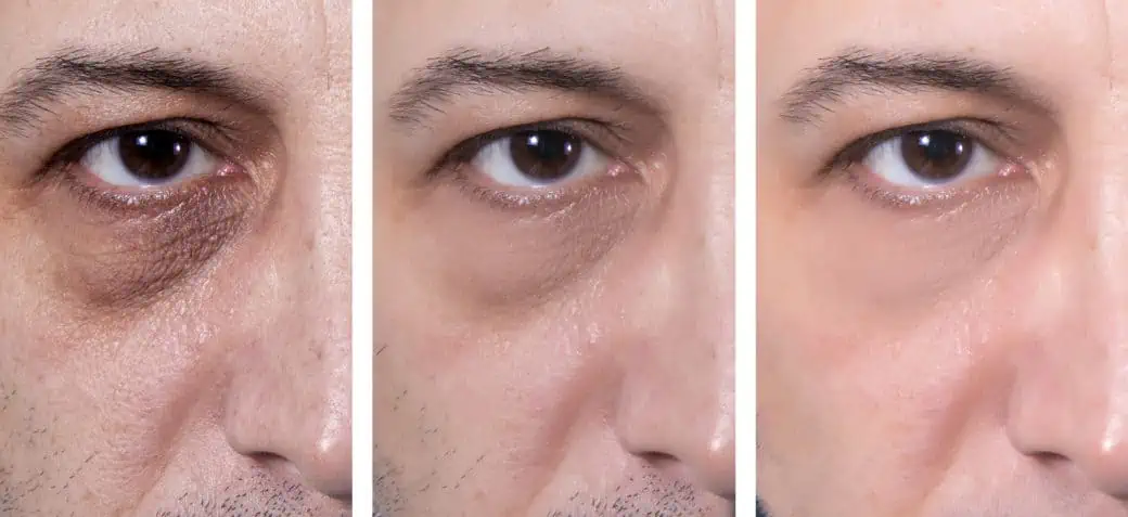 Mezoterapia bezigłowa na okolice oka (+ redukcja cieni pod oczami)
