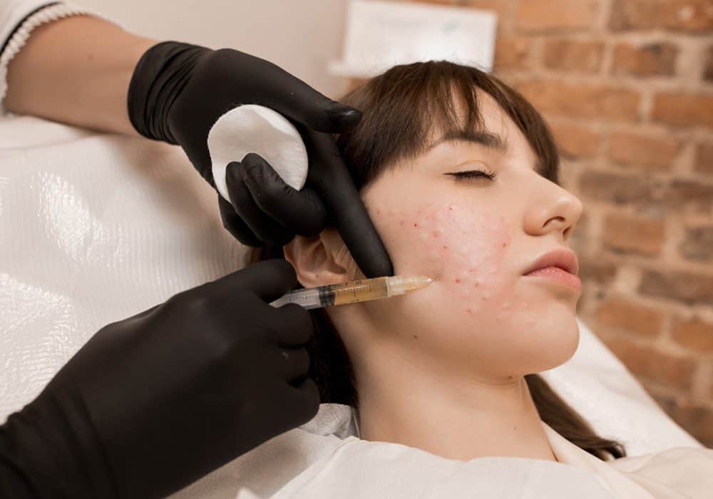 Mezoterapia igłowa – zrób coś dla swojej skóry!