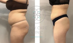 Endermologia zabieg na cellulit Katowice